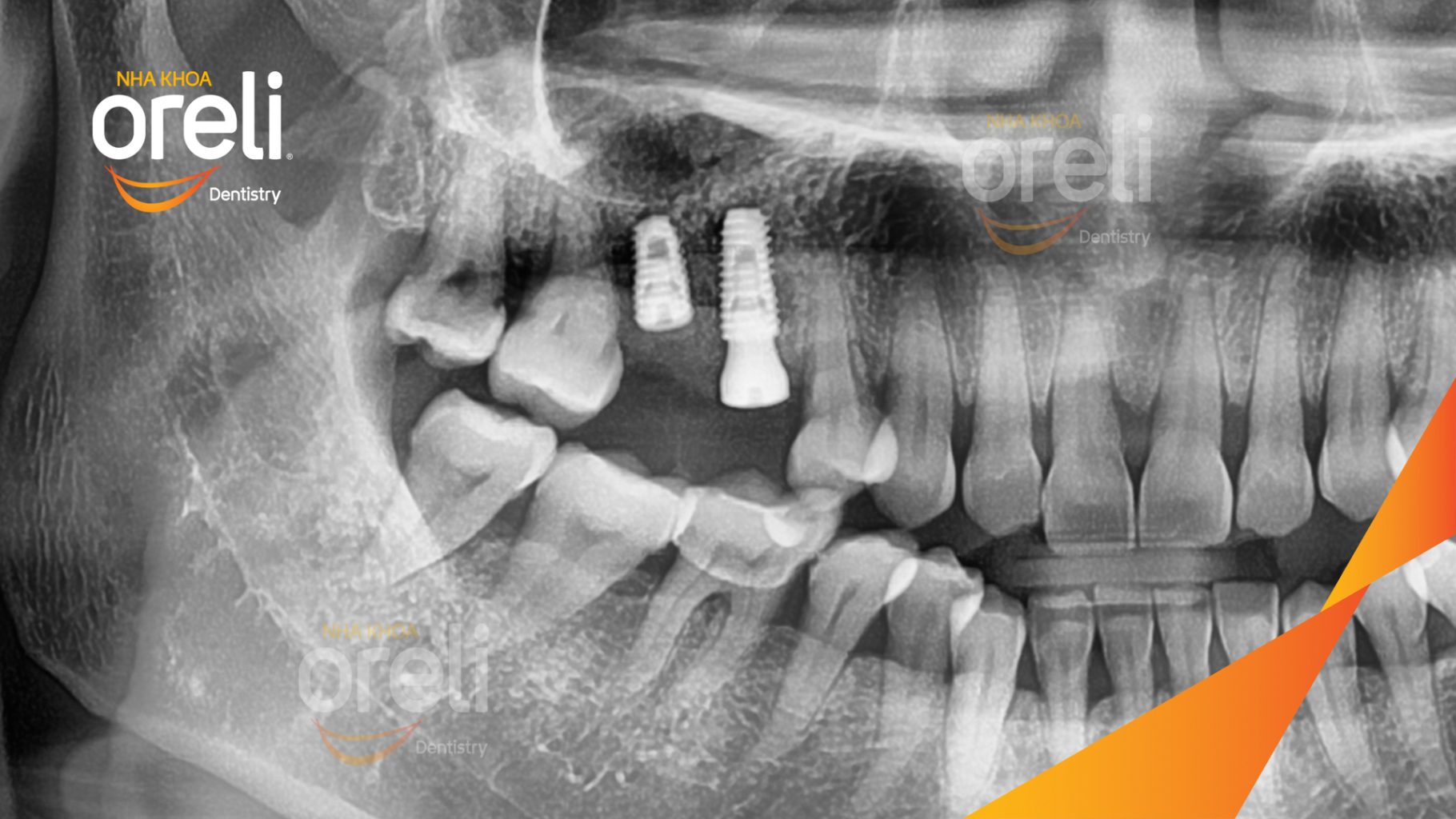 Mất răng hàm trên trước khi điều trị tại Oreli