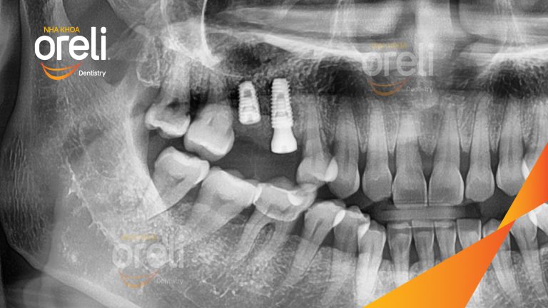 Ca Cấy Ghép Implant Phục Hồi Răng Tại Nha Khoa Oreli