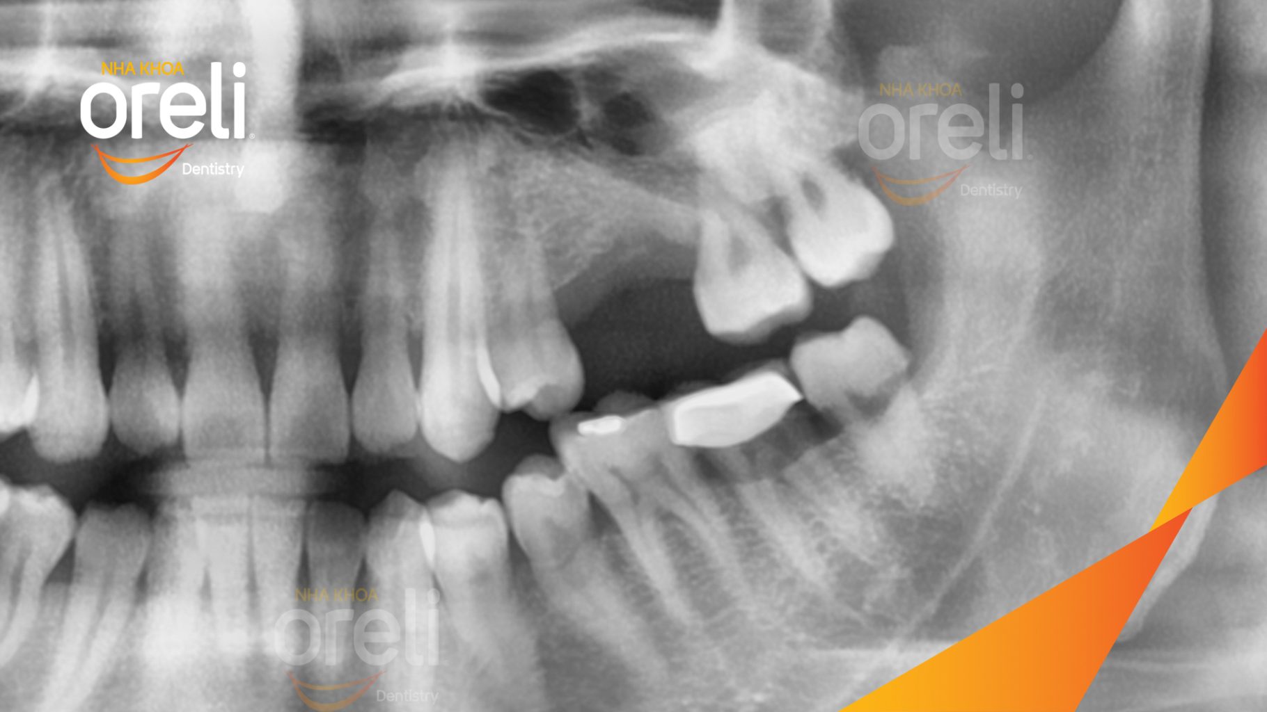 Trước điều trị: Mất răng hàm trên tại Oreli