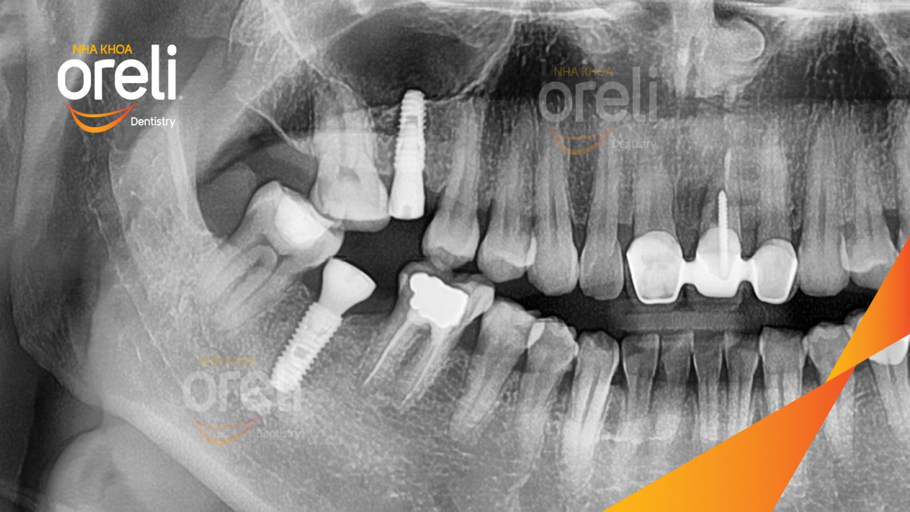 Mất răng hàm trên và dưới trước khi điều trị tại Oreli