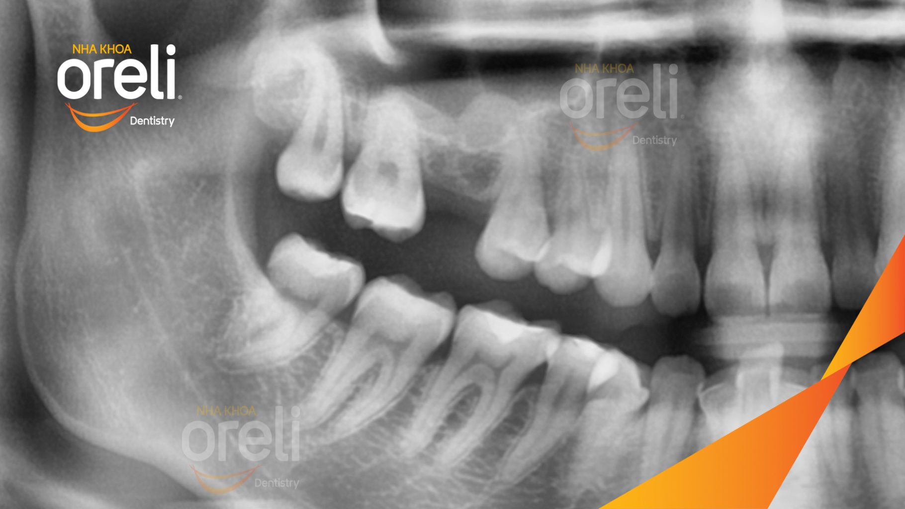 Trước điều trị: Mất răng hàm trên tại Oreli