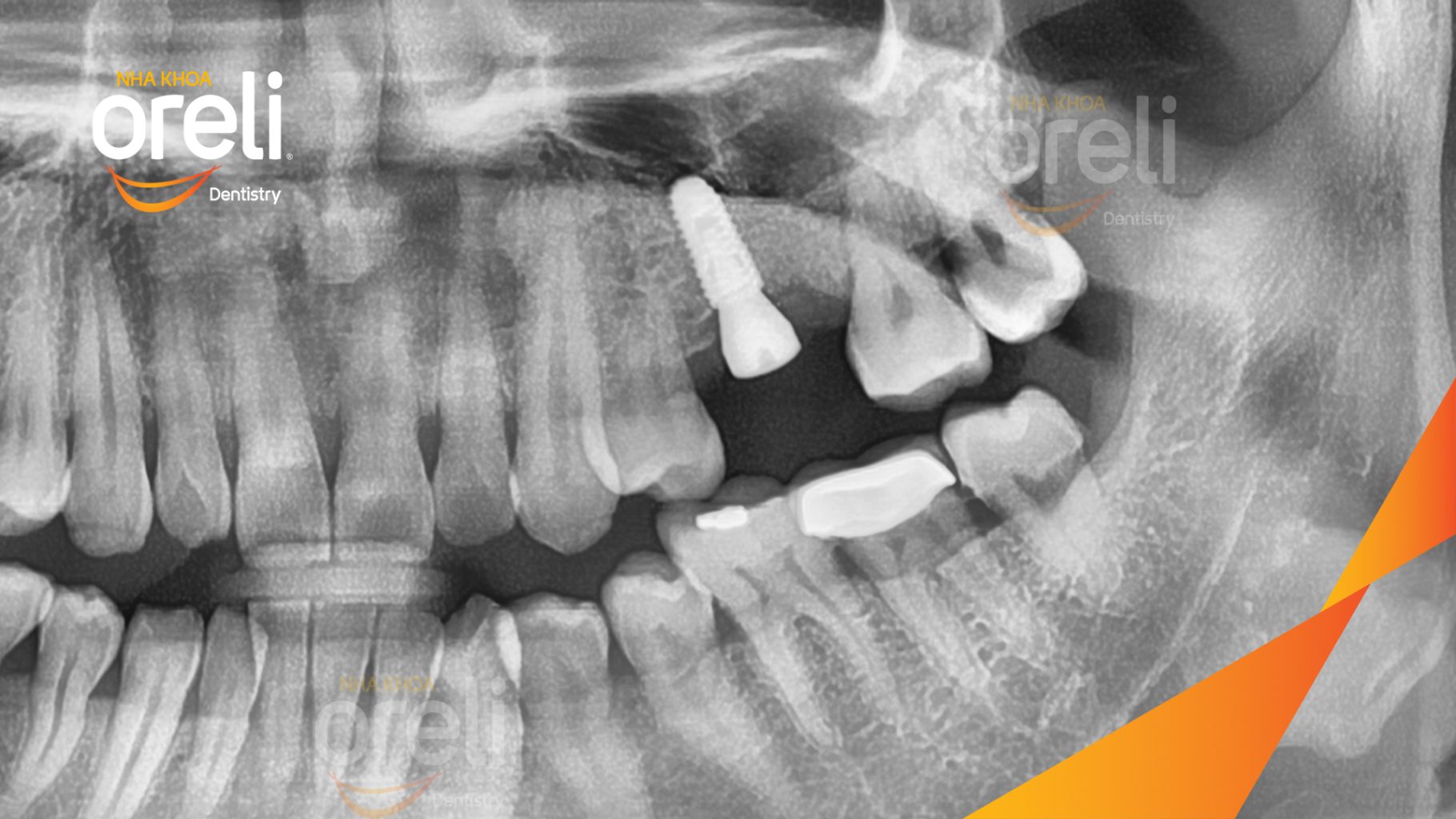 Mất răng hàm trên trước khi điều trị tại Oreli