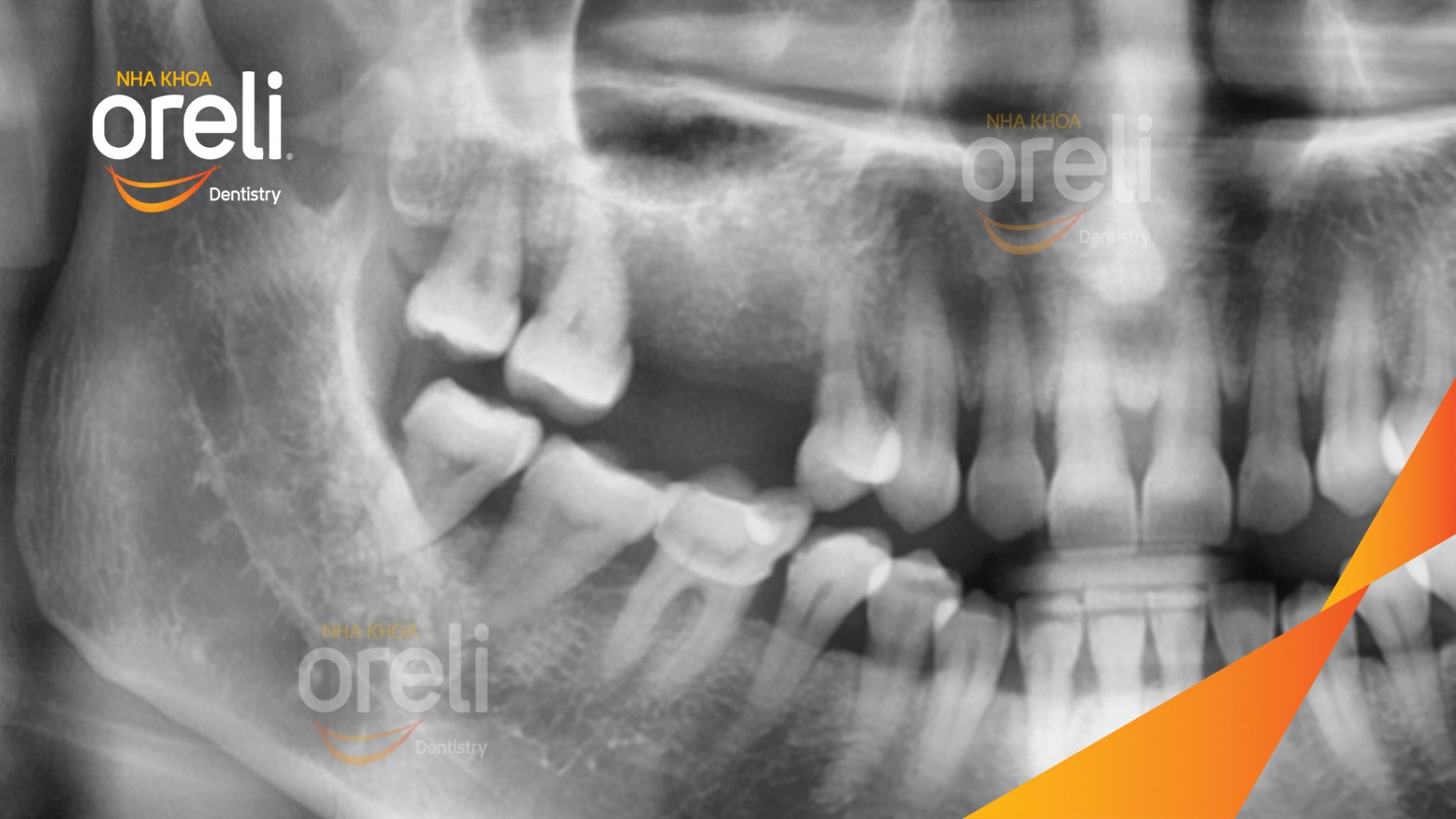 Trước điều trị: Mất răng hàm trên tại Oreli