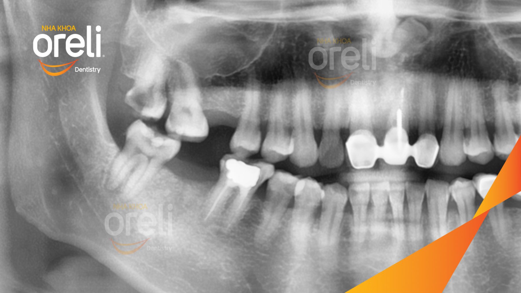 Trước điều trị: Mất răng hàm trên và dưới tại Oreli