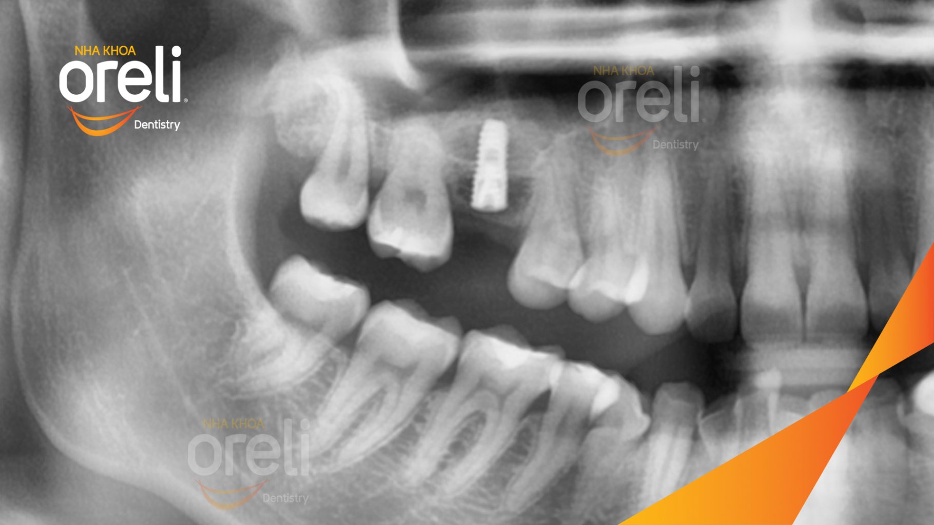 Mất răng hàm trên trước khi điều trị tại Oreli