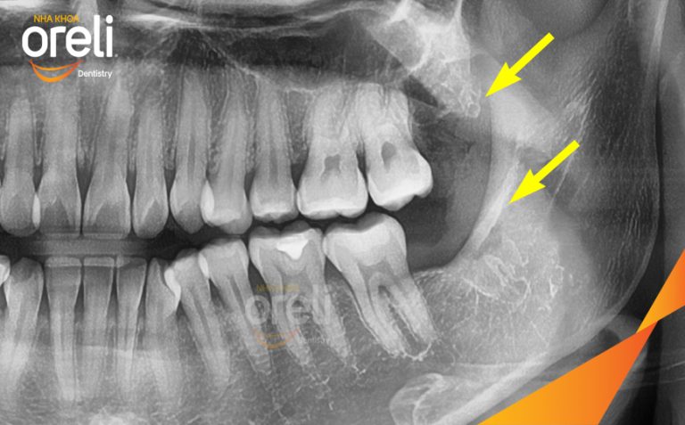 Ca Nhổ Răng Khôn Tại Buôn Ma Thuột | Nha khoa Oreli
