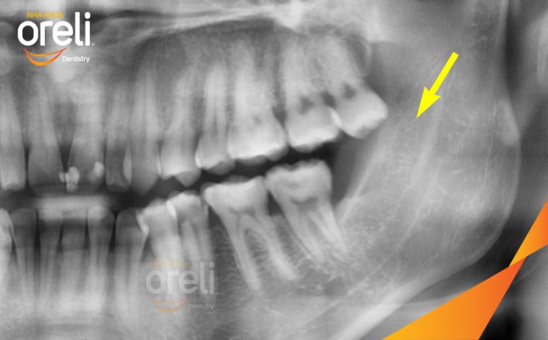 Nhổ răng khôn hàm dưới – Case thực tế tại Oreli Buôn Ma Thuột