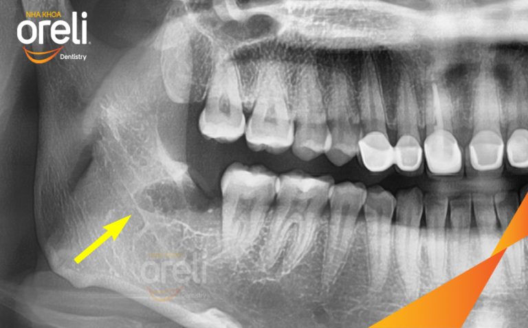 Ca Nhổ Răng Khôn Mọc Lệch Tại Buôn Ma Thuột | Nha khoa Oreli