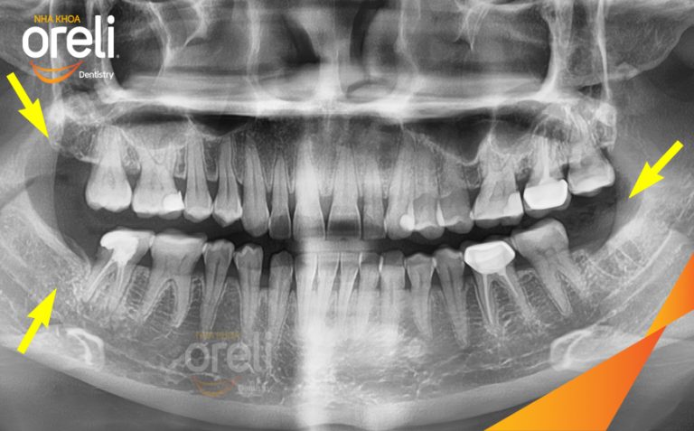 Ca Nhổ Răng Khôn Mọc Lệch Tại Buôn Ma Thuột | Nha khoa Oreli