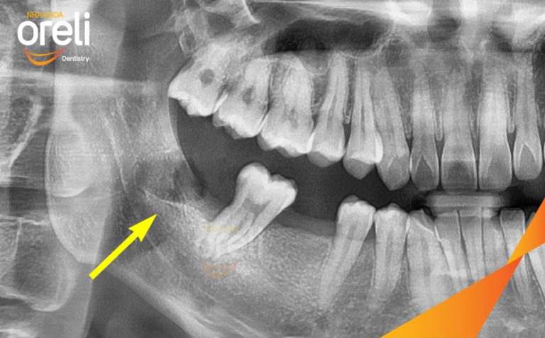 Nhổ răng khôn hàm dưới – Case thực tế tại Oreli Buôn Ma Thuột