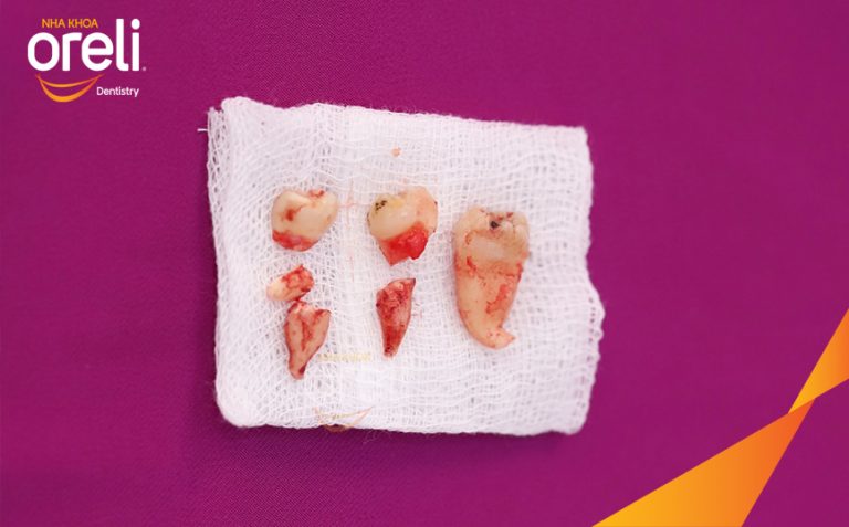 Ca Nhổ Răng Khôn Tại Buôn Ma Thuột | Nha khoa Oreli