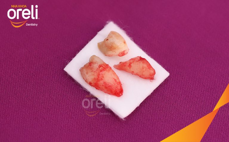 Nhổ răng khôn hàm dưới – Case thực tế tại Oreli Buôn Ma Thuột
