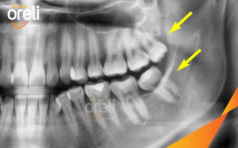 Ca Nhổ Răng Khôn Tại Buôn Ma Thuột | Nha khoa Oreli