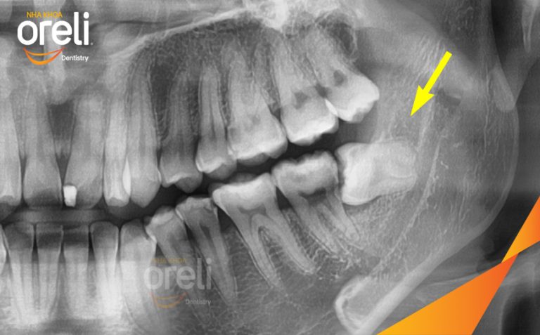 Nhổ răng khôn hàm dưới – Case thực tế tại Oreli Buôn Ma Thuột