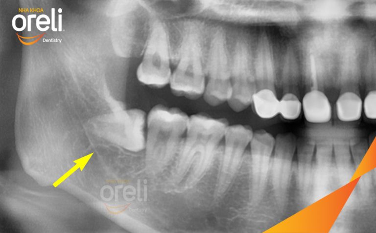 Ca Nhổ Răng Khôn Mọc Lệch Tại Buôn Ma Thuột | Nha khoa Oreli