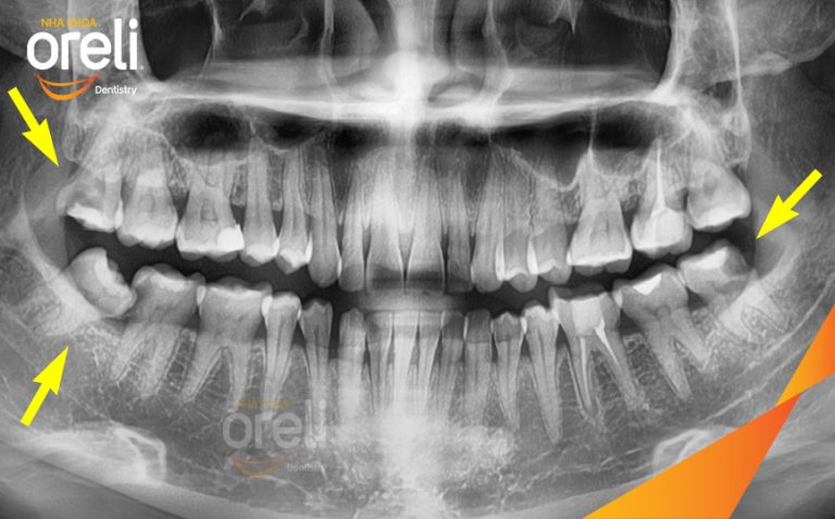 Ca Nhổ Răng Khôn Mọc Lệch Tại Buôn Ma Thuột | Nha khoa Oreli
