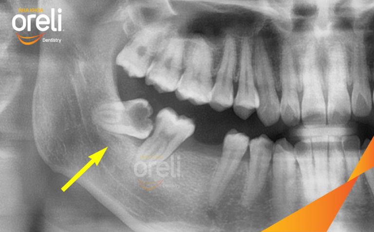 Nhổ răng khôn hàm dưới – Case thực tế tại Oreli Buôn Ma Thuột