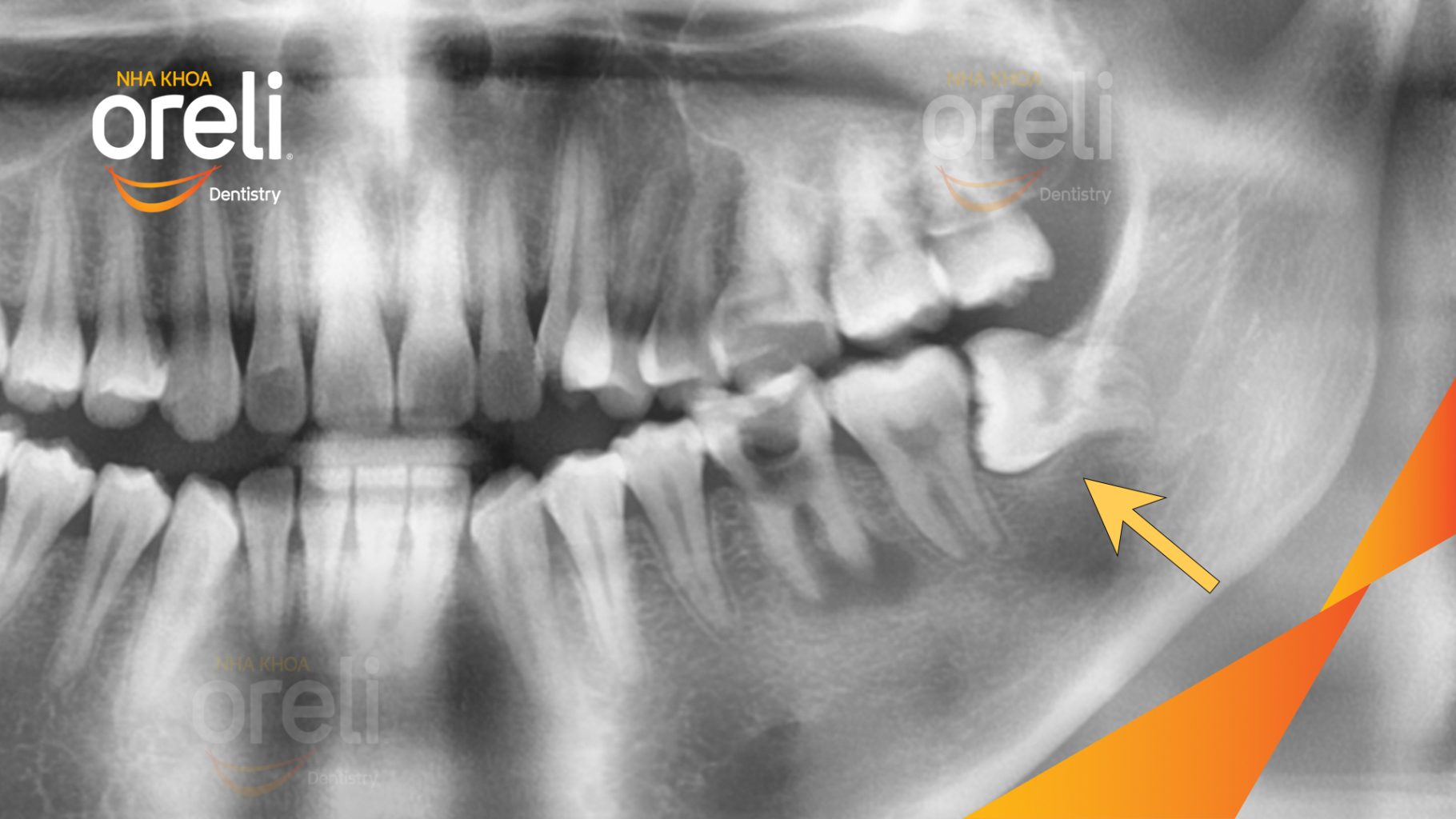 Trước điều trị: Răng khôn hàm dưới mọc lệch tại Oreli