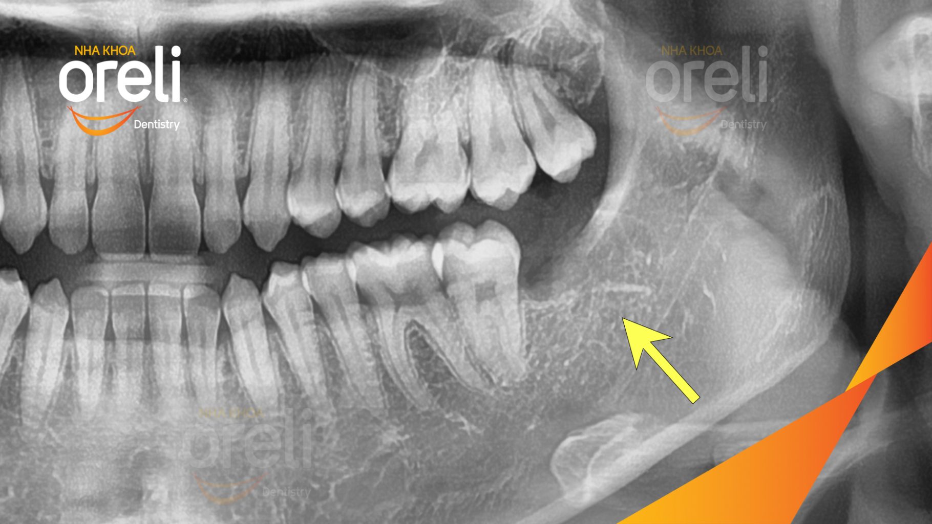 Răng khôn hàm dưới mọc lệch trước khi điều trị tại Oreli