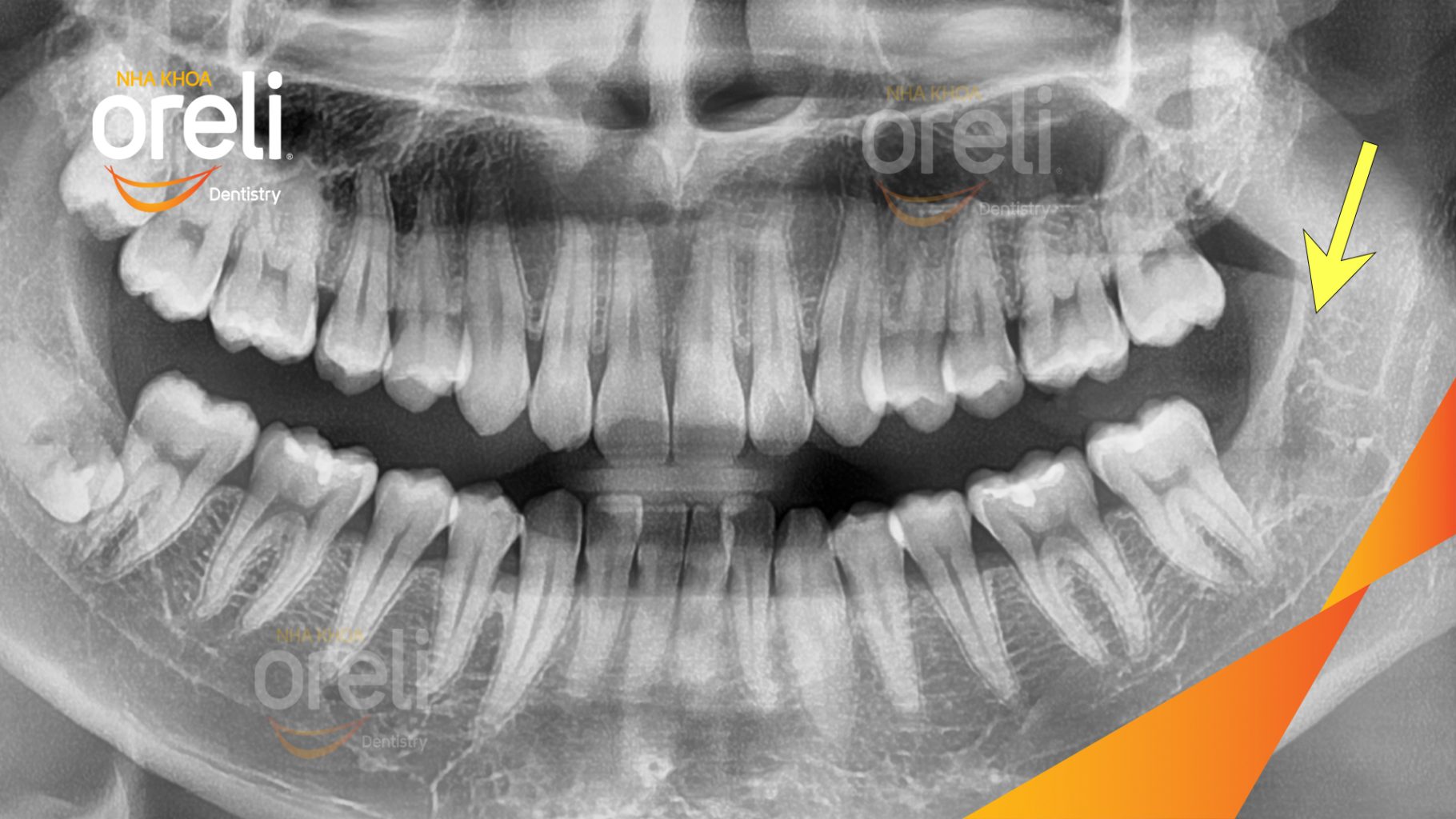 Răng khôn hàm dưới mọc lệch trước khi điều trị tại Oreli