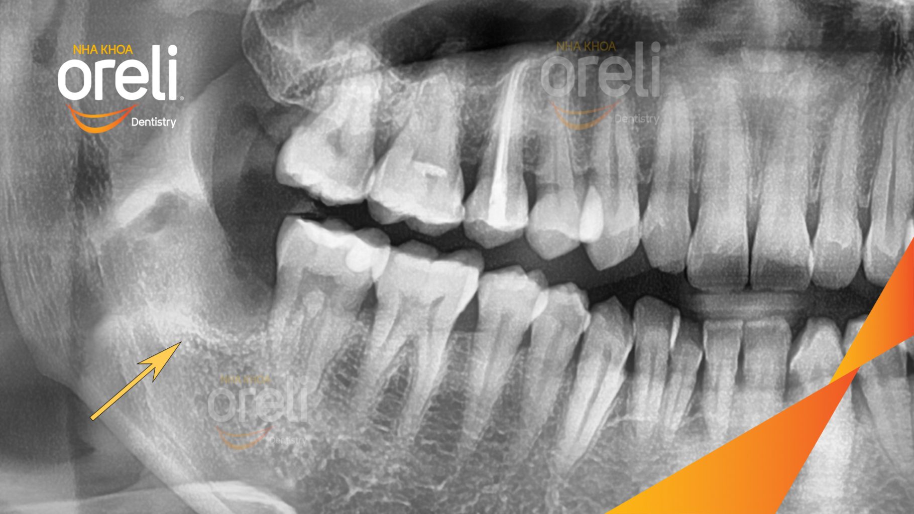 Răng khôn hàm dưới mọc lệch trước khi điều trị tại Oreli