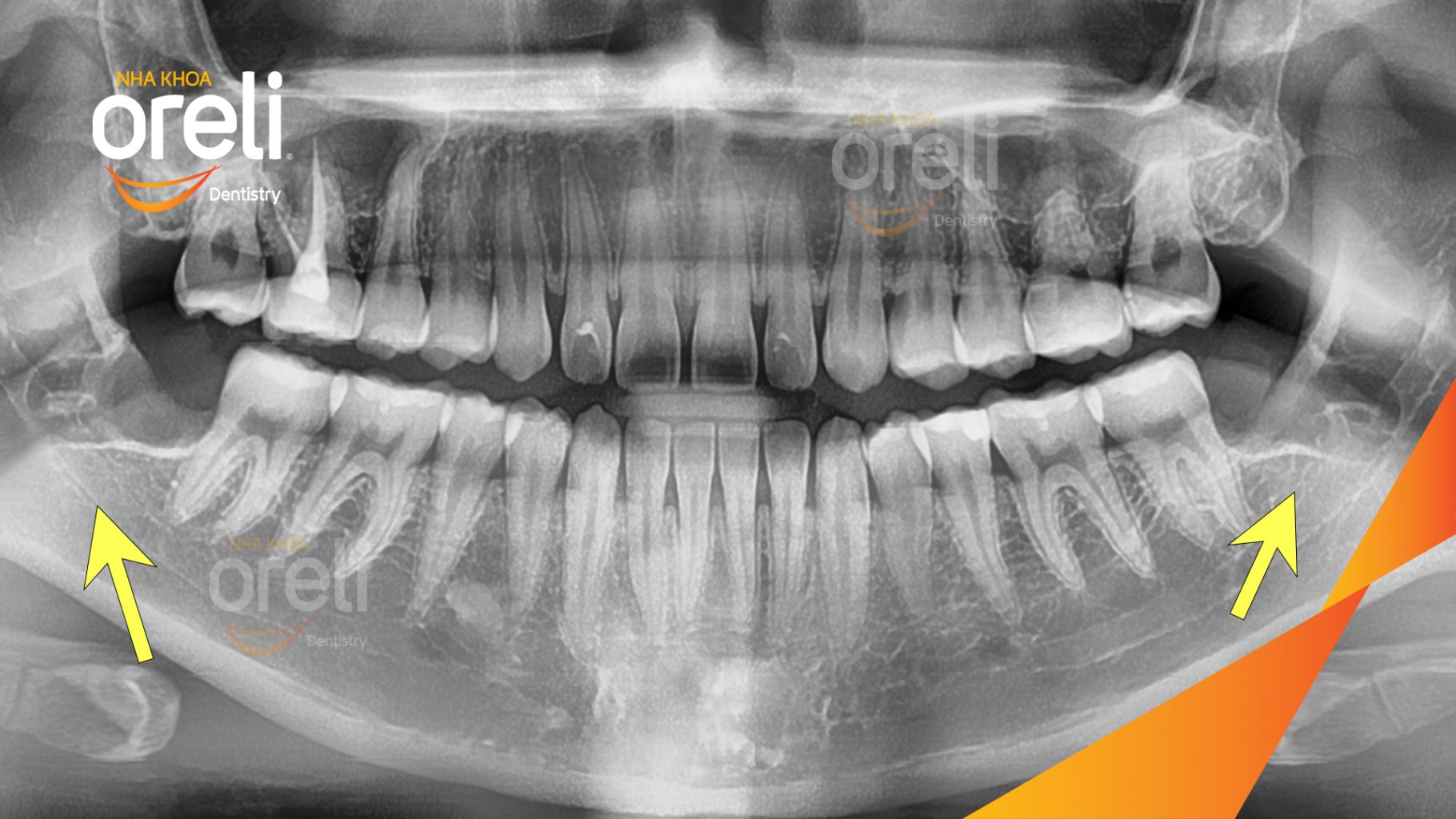 Răng khôn hàm dưới mọc lệch trước khi điều trị tại Oreli