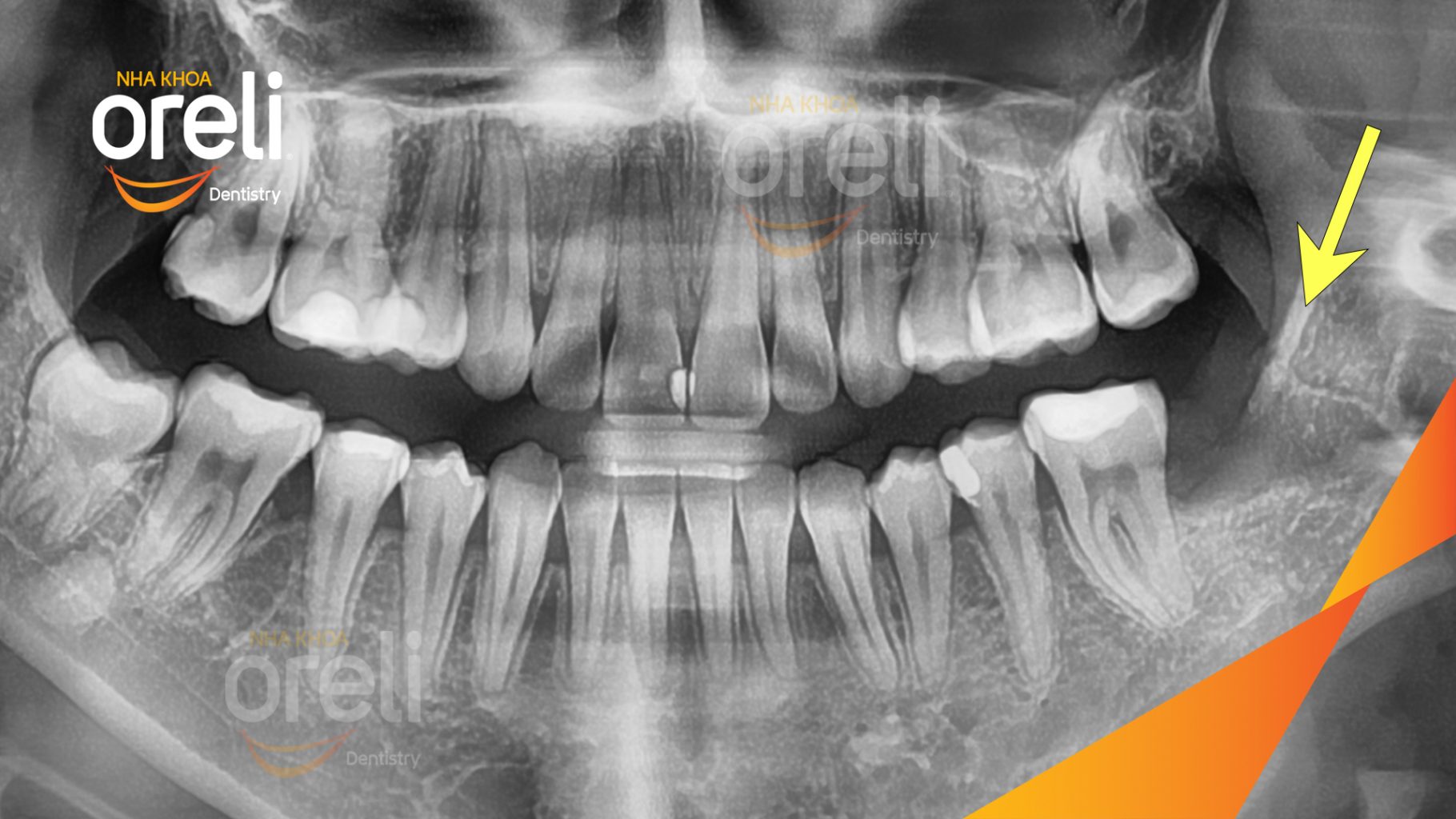Răng khôn hàm dưới mọc lệch trước khi điều trị tại Oreli