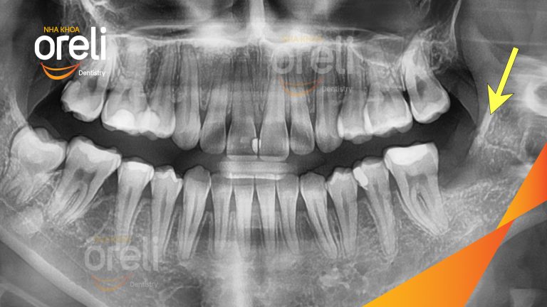 Nhổ răng khôn hàm dưới – Case thực tế tại Oreli Buôn Ma Thuột