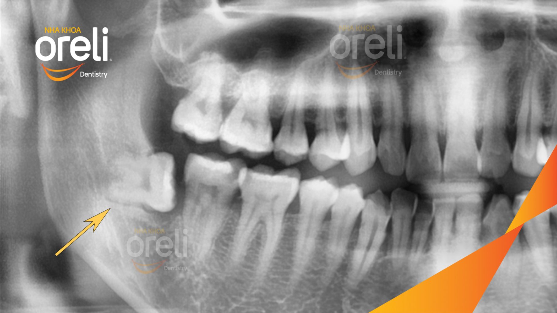 Trước điều trị: Răng khôn hàm dưới mọc lệch tại Oreli