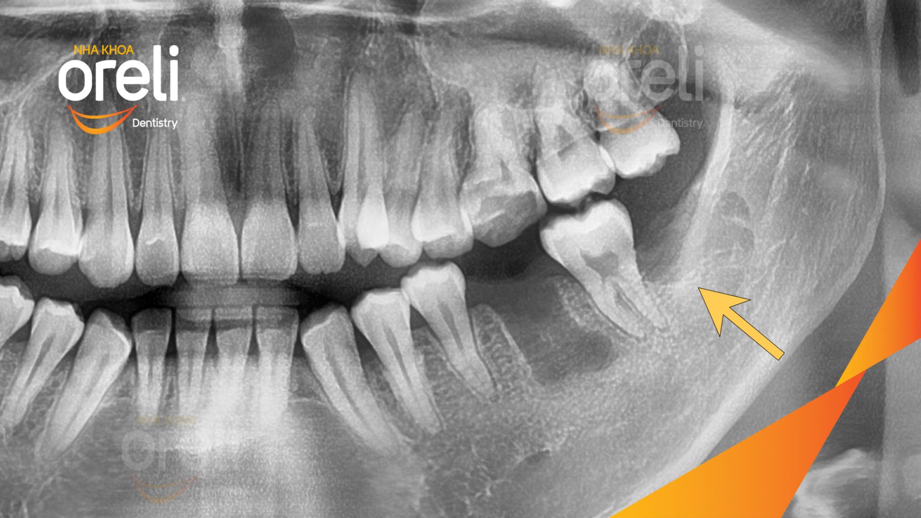 Răng khôn hàm dưới mọc lệch trước khi điều trị tại Oreli