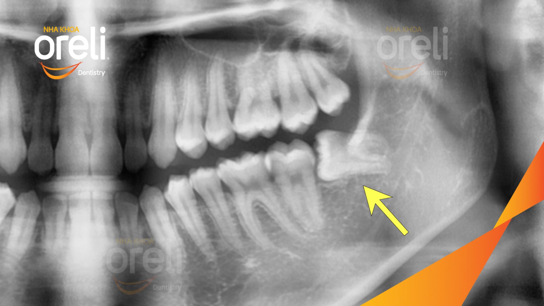Trước điều trị: Răng khôn hàm dưới mọc lệch tại Oreli