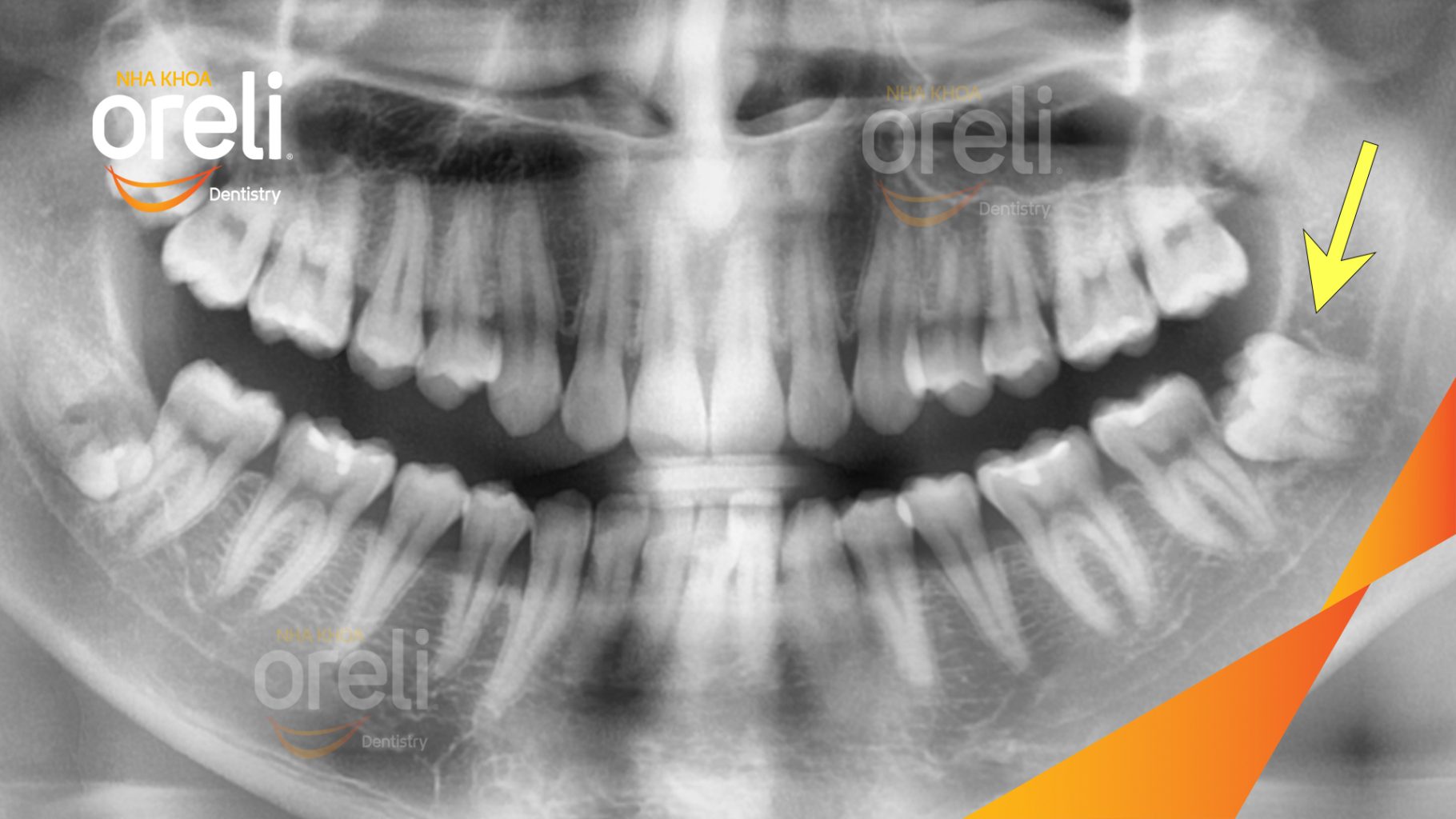 Trước điều trị: Răng khôn hàm dưới mọc lệch tại Oreli