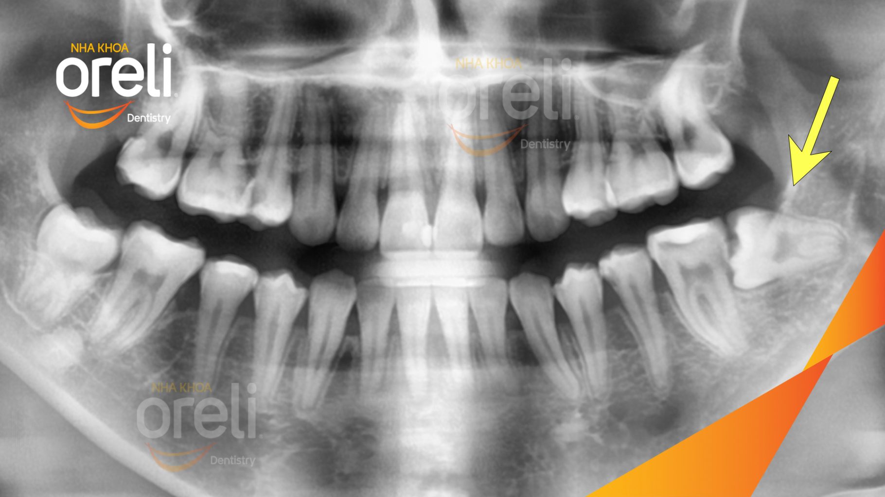 Trước điều trị: Răng khôn hàm dưới mọc lệch tại Oreli