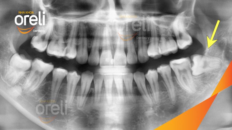 Nhổ răng khôn hàm dưới – Case thực tế tại Oreli Buôn Ma Thuột