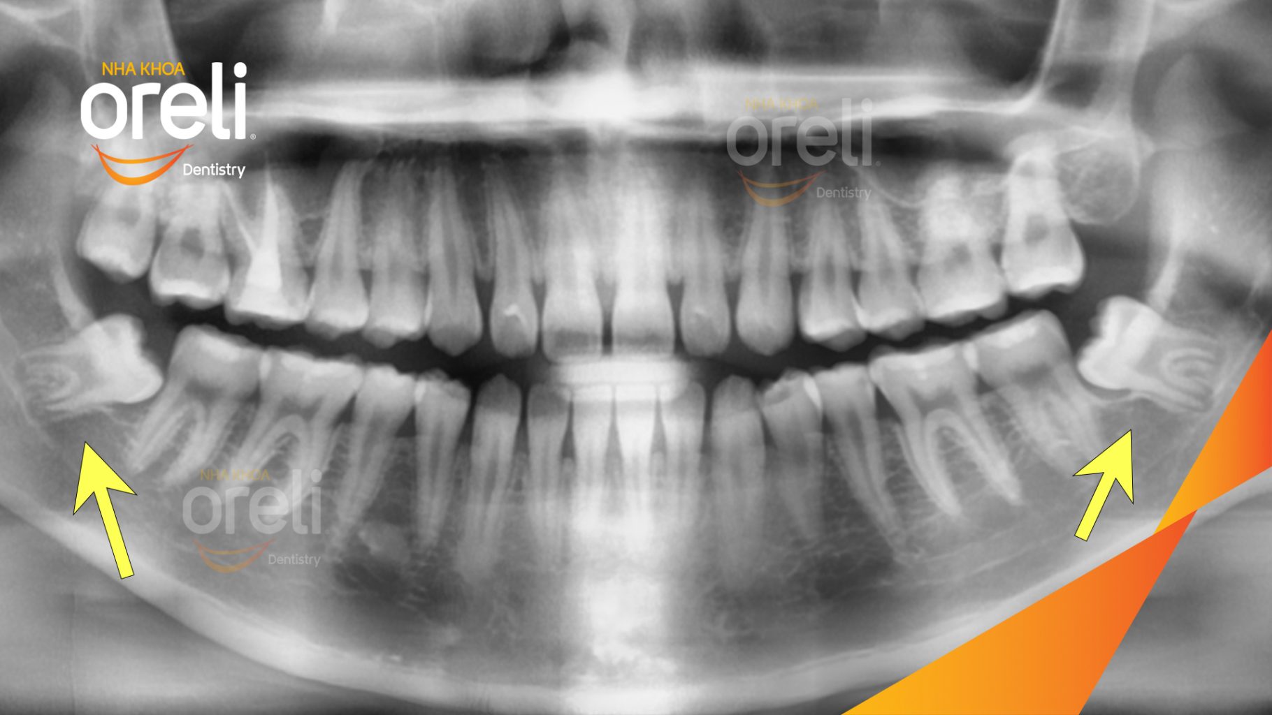 Trước điều trị: Răng khôn hàm dưới mọc lệch tại Oreli