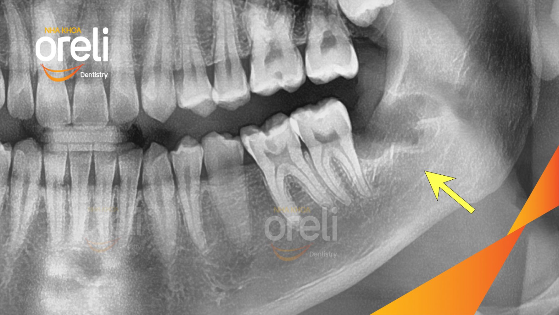 Răng khôn hàm dưới mọc lệch trước khi điều trị tại Oreli