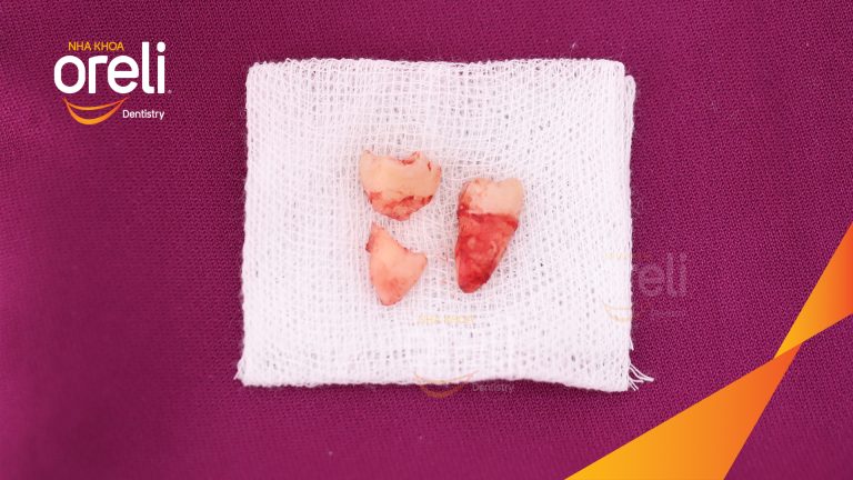 Nhổ răng khôn hàm dưới – Case thực tế tại Oreli Buôn Ma Thuột