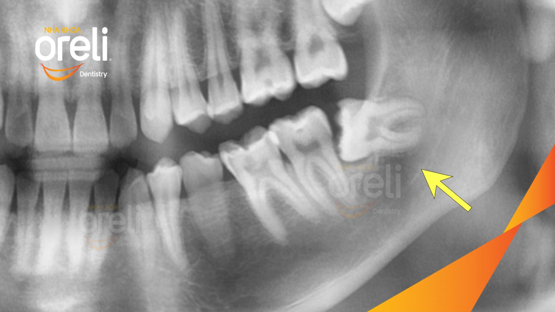 Trước điều trị: Răng khôn hàm dưới mọc lệch tại Oreli