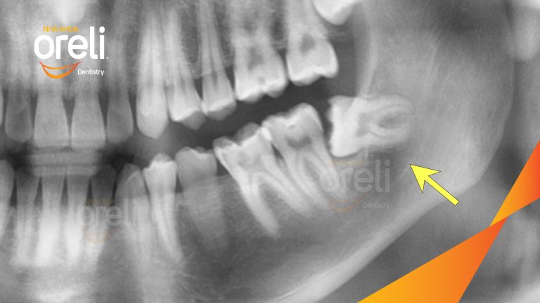 Nhổ răng khôn hàm dưới – Case thực tế tại Oreli Buôn Ma Thuột