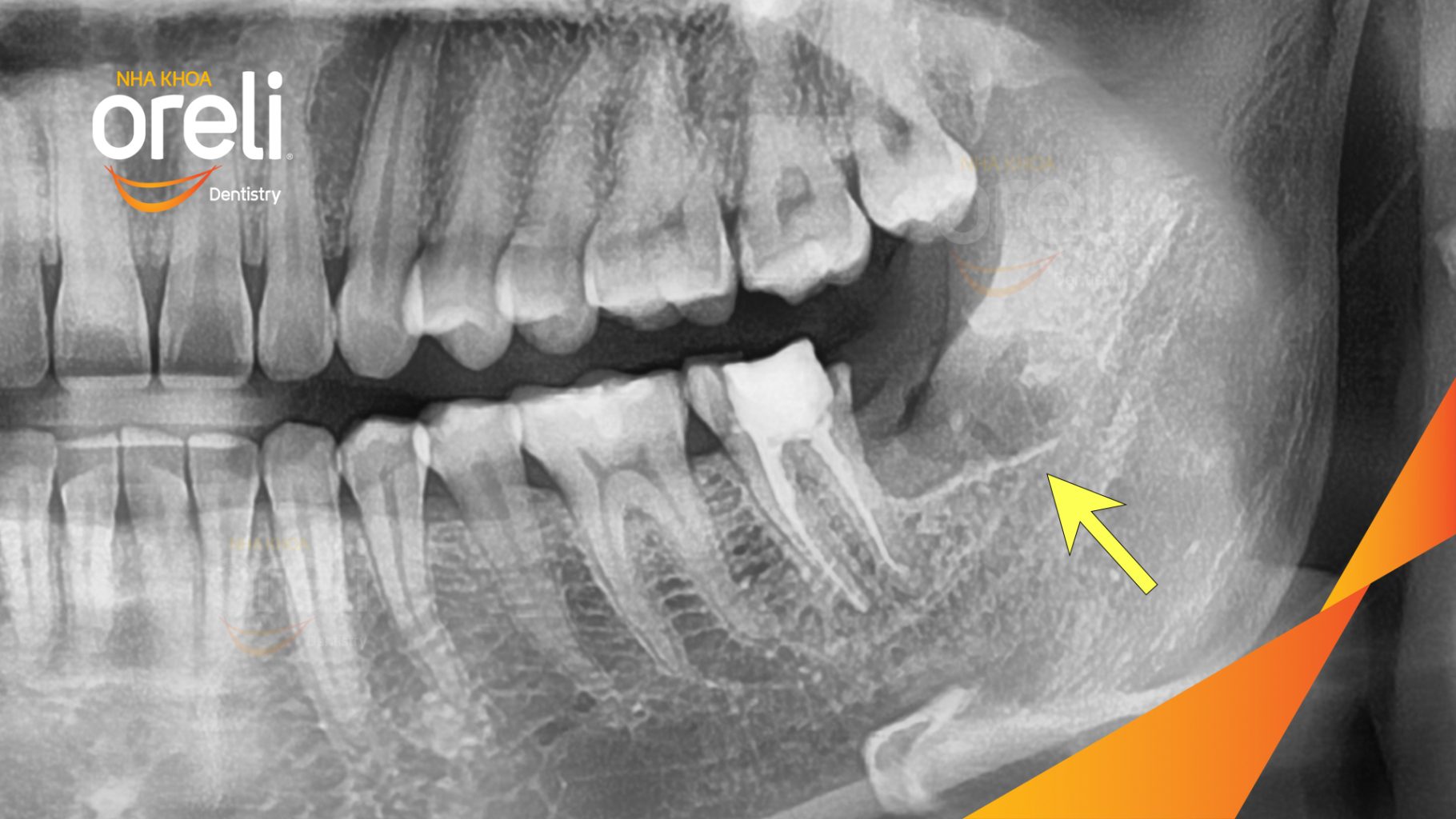Răng khôn hàm dưới mọc lệch trước khi điều trị tại Oreli