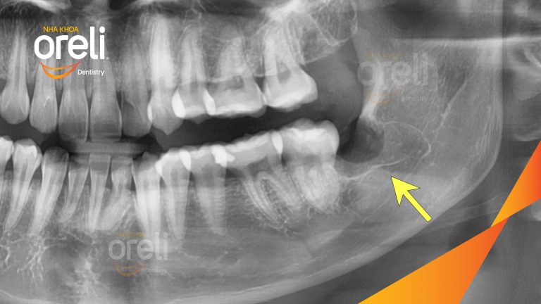 Ca Nhổ Răng Khôn Mọc Lệch Tại Buôn Ma Thuột | Nha khoa Oreli