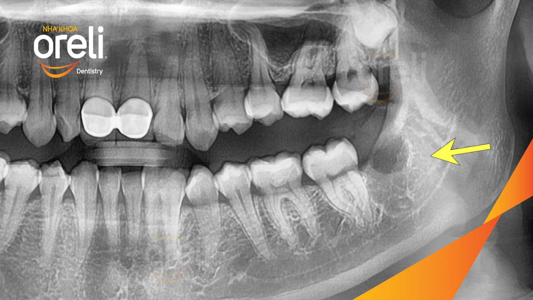 Răng khôn hàm dưới gây đau nhức trước khi điều trị tại Oreli