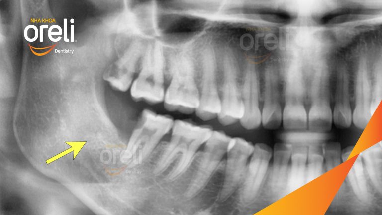 Ca Nhổ Răng Khôn Mọc Lệch Tại Buôn Ma Thuột | Nha khoa Oreli