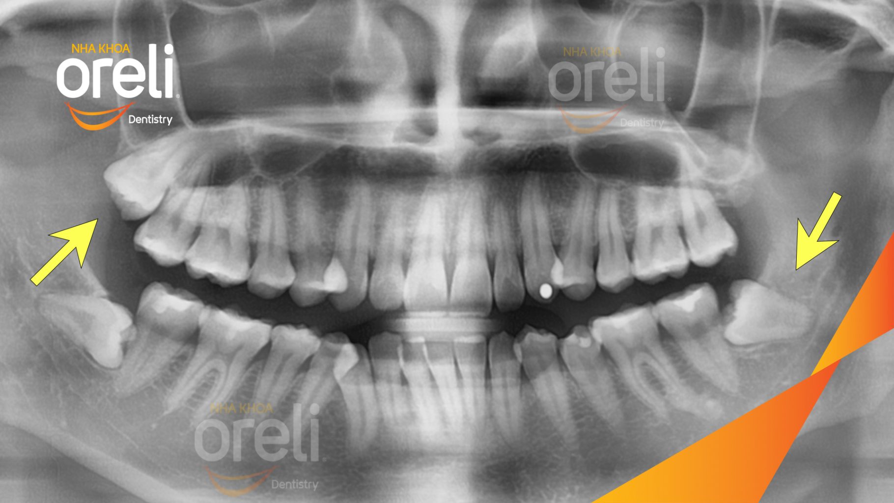 Trước điều trị: Mất răng hàm trên và dưới tại Oreli