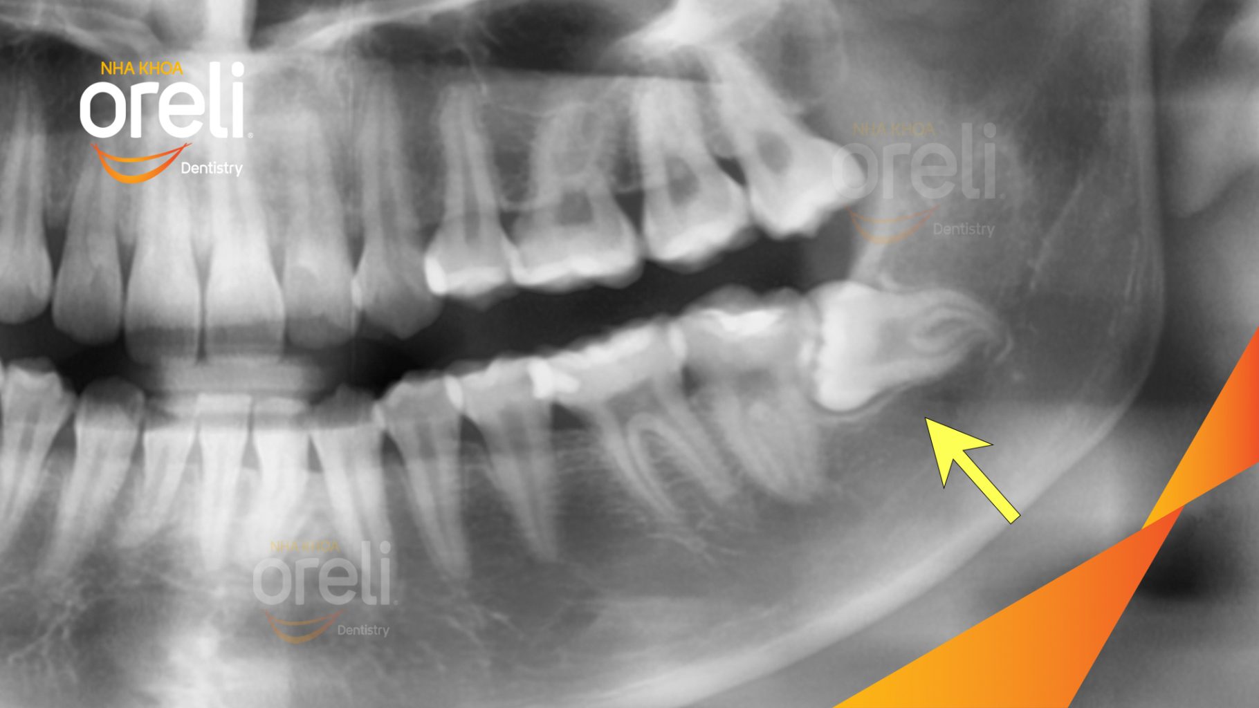 Trước điều trị: Răng khôn hàm dưới mọc lệch tại Oreli