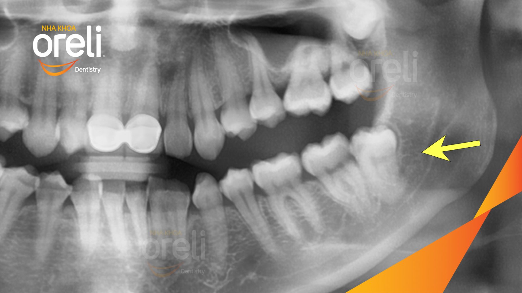 Trước điều trị: Răng khôn hàm dưới gây đau nhức tại Oreli