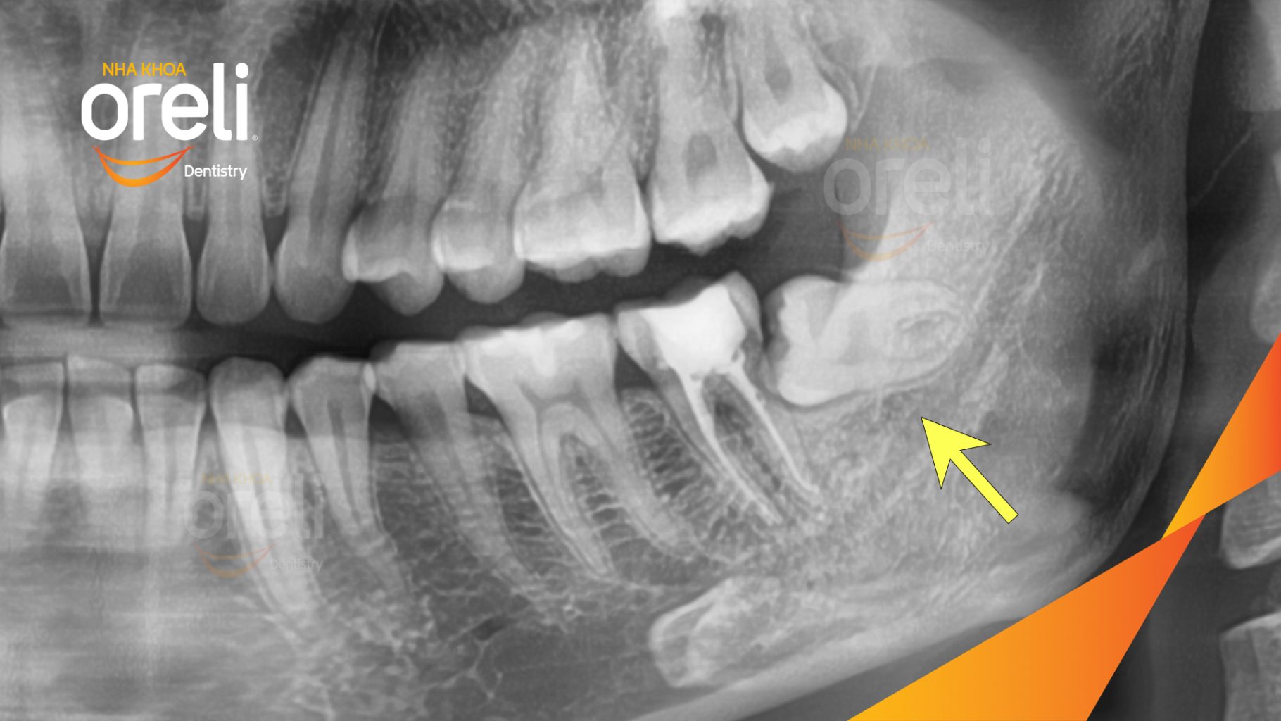 Trước điều trị: Răng khôn hàm dưới mọc lệch tại Oreli