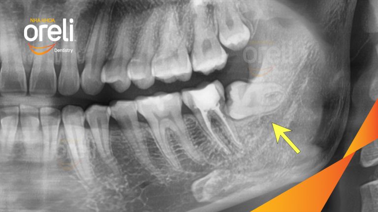 Nhổ răng khôn hàm dưới – Case thực tế tại Oreli Buôn Ma Thuột