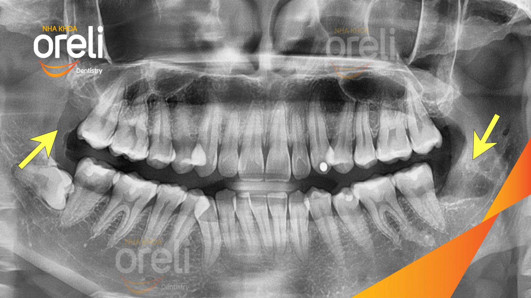 Mất răng hàm trên và dưới trước khi điều trị tại Oreli