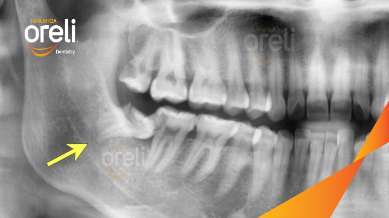 Ca Nhổ Răng Khôn Mọc Lệch Tại Buôn Ma Thuột | Nha khoa Oreli